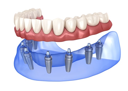 precio implante dental en valencia