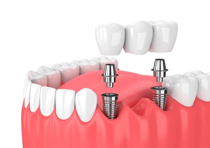 Implante dental precio Valencia