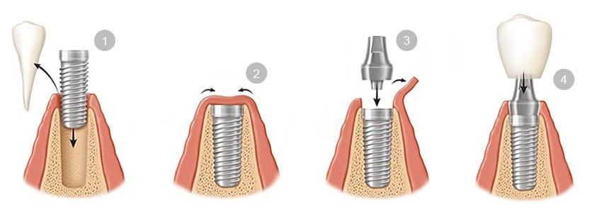Las fases de colocación de un implante dental