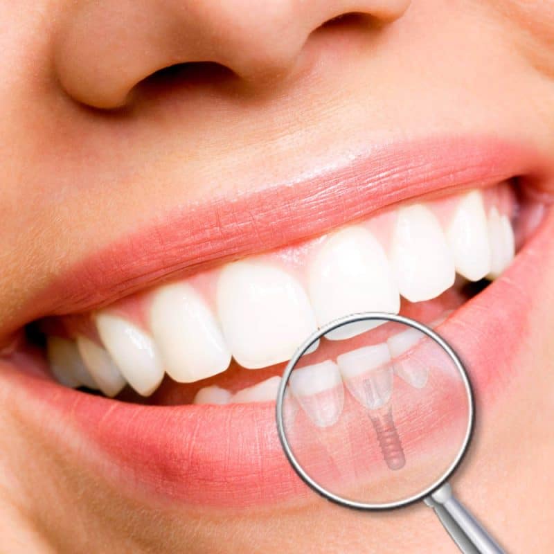 fases implante dental