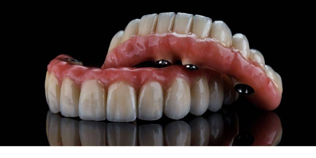 Tipos de Prótesis Dental